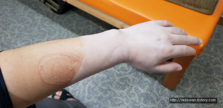 대구 수성구 지산동 황금연합신경외과의원. 어깨아파서팔안올라감, 손목염증 완치 작업 사진 3