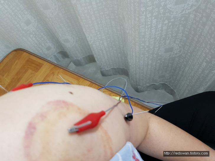 별점5/5점. 경산 하양 한의원 추천. 유성한의원. 허리삐끗. 어깨통증 팔 안 올라감. 작업 사진 5